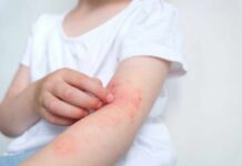 Child's arm showing skin irritation and redness