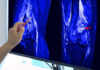 Bone Health: Diet vs. Workouts A hand pointing at an MRI scan of a knee joint on a monitor