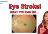Sudden Vision Loss? It Could Be an Eye Stroke (BE FAST)