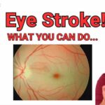 Sudden Vision Loss? It Could Be an Eye Stroke (BE FAST)