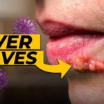 Herpes: Why It HIDES in Your Nerves Forever