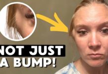 Diagnosed With Leiomyosarcoma: The RARE CANCER Symptom I Couldn't Ignore