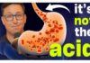 The Acid Reflux Diet I Recommend to All My Patients