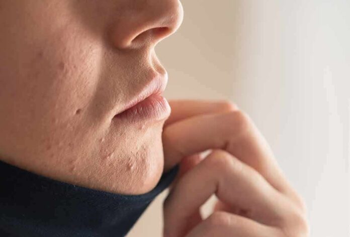 shutterstock_1866830254 Close-up of lower face with acne scars and hand pulling up fabric